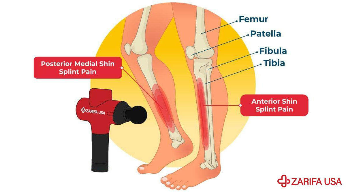 Read more about the article Massage Gun for Shin Splints: Soothe Pain Quickly