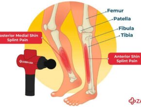 Does Vibration Help Shin Splints?