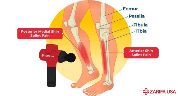 Does Vibration Help Shin Splints?