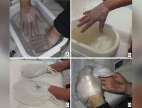Can Paraffin Wax Bath Machines Help With Eczema