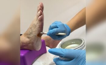 Can Paraffin Wax Bath Machines Help With Plantar Fasciitis