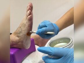 Do Paraffin Wax Bath Machines Help With Psoriasis