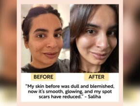 Is Gua Sha Good for Acne-Prone Skin