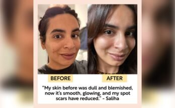 Is Gua Sha Good for Acne-Prone Skin