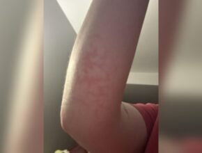 Can Heating Pads Cause Burns?