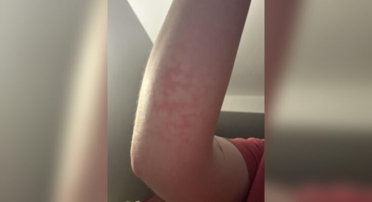 Can Heating Pads Cause Burns?